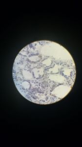 Жировая дистрофия клеток эпителия извитых канальцев почки 3