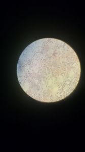 Зернистая дистрофия клеток эпителия извитых канальцев почки 2