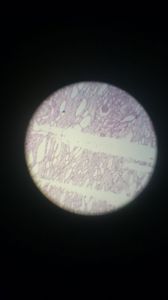 Гидропическая дистрофия клеток эпителия извитых канальцев почки 1