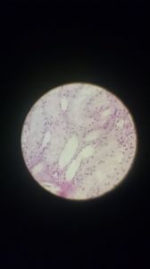 Гидропическая дистрофия клеток эпителия извитых канальцев почки 2