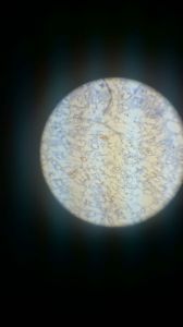 Жировая дистрофия клеток эпителия извитых канальцев почки 1