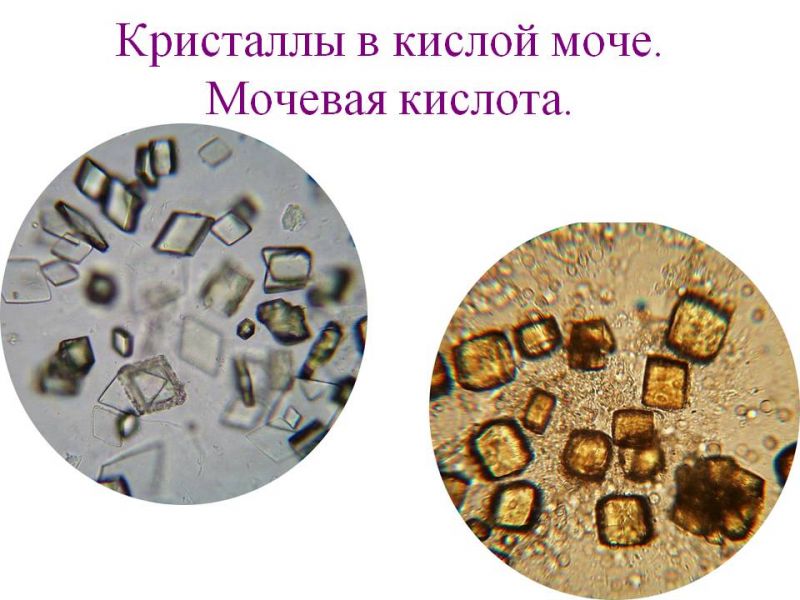 Высокая соль в моче. Соли мочевой кислоты в моче микроскопия. Мочевая кислота микроскопия мочи. Микроскопия мочи Кристаллы мочевой кислоты. Соли мочевой кислоты микроскопия.