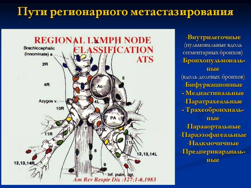 Региональные лимфатические узлы. Метастазирование в регионарные лимфоузлы. Метастазы в легких лимфоузлы