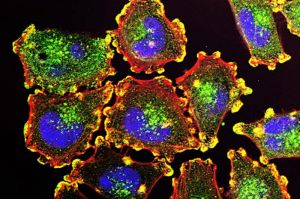 metastatic-melanoma-cells-courtesy-of-nih-1188x792-1188x792.jpg