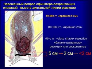 rectum50.jpg